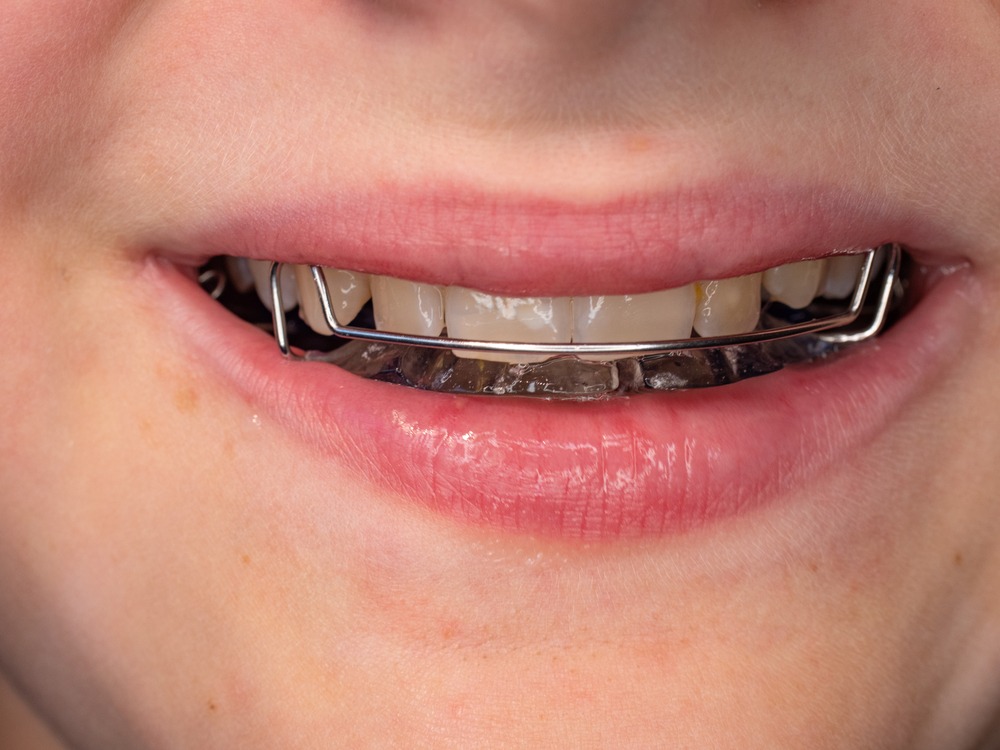 aparato dento-faciales (ortodoncia)