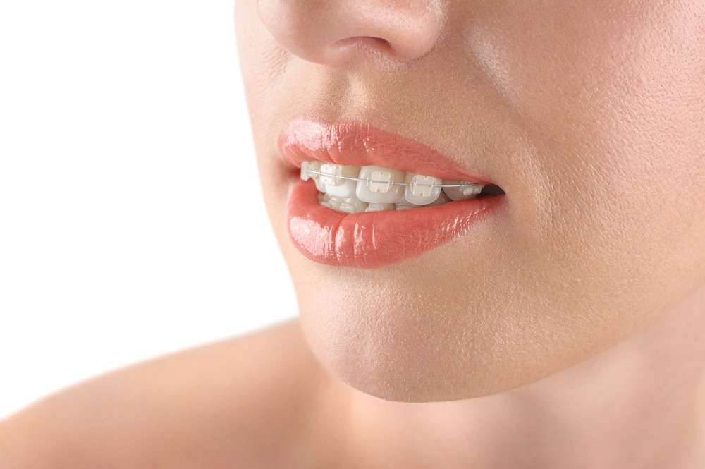 braces (ortodoncia)