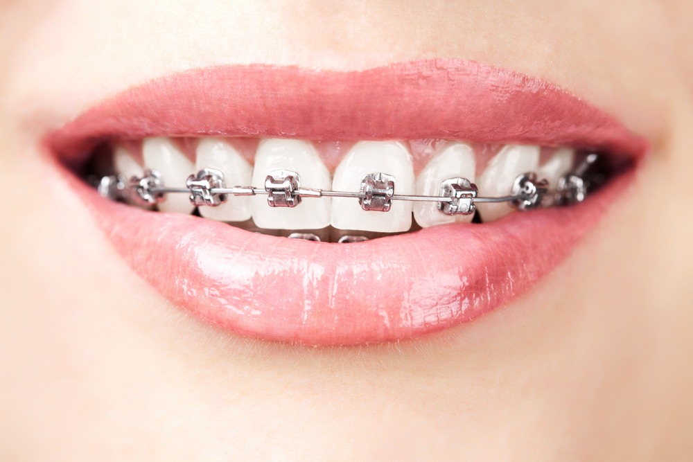 braces(ortodoncia)